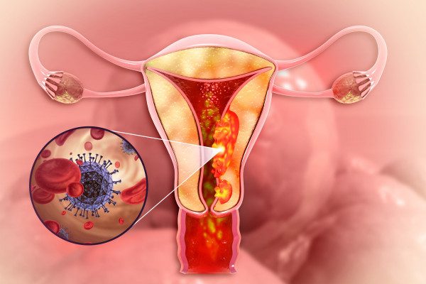 Ultrazvukem navigovaná tru-cut biopsie v léčbě gynekologických maligních nádorů